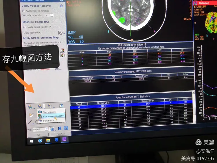 飞利浦ct脑灌注后处理方法！